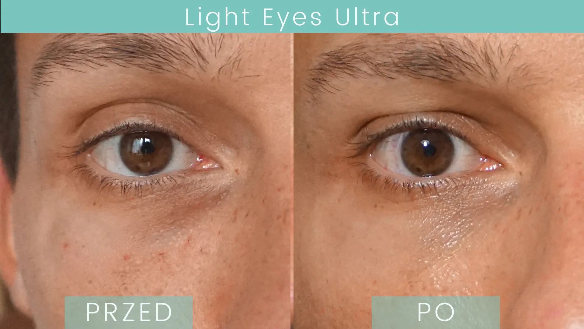 Light Eyes Ultra Efekty Przed i Po